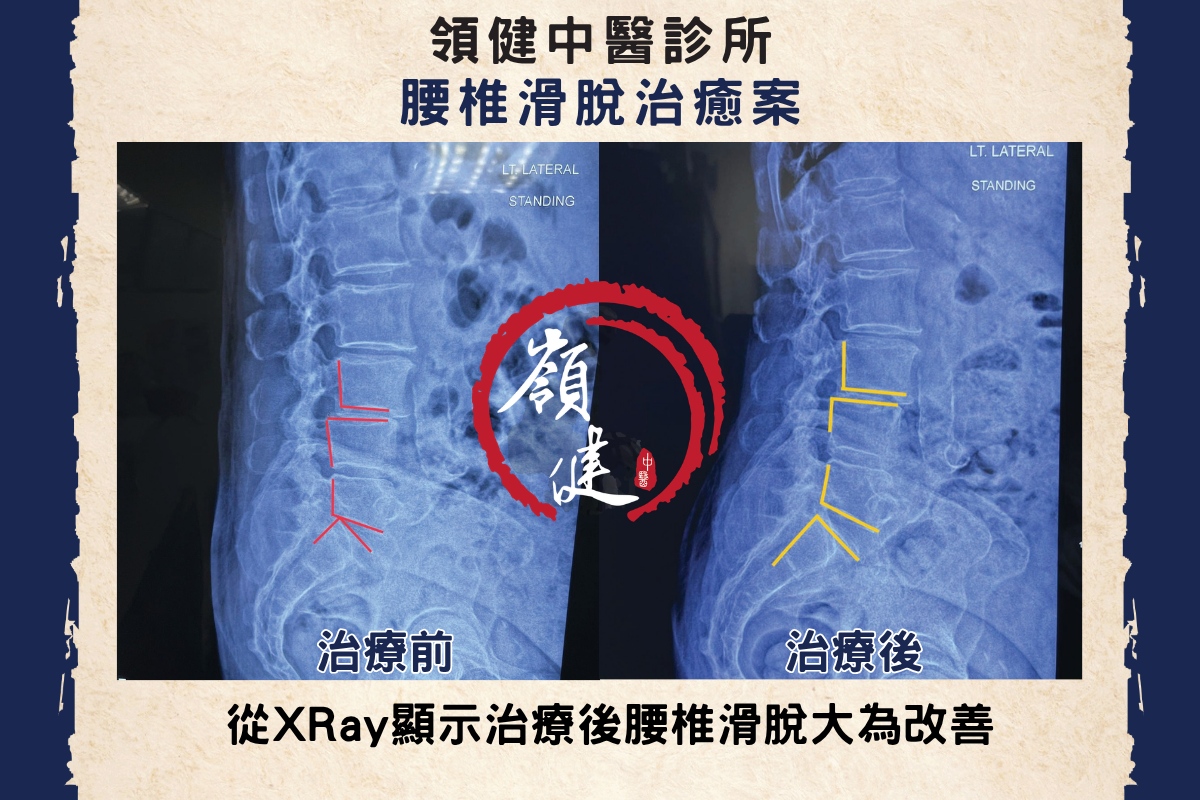 腰椎滑脫治癒案