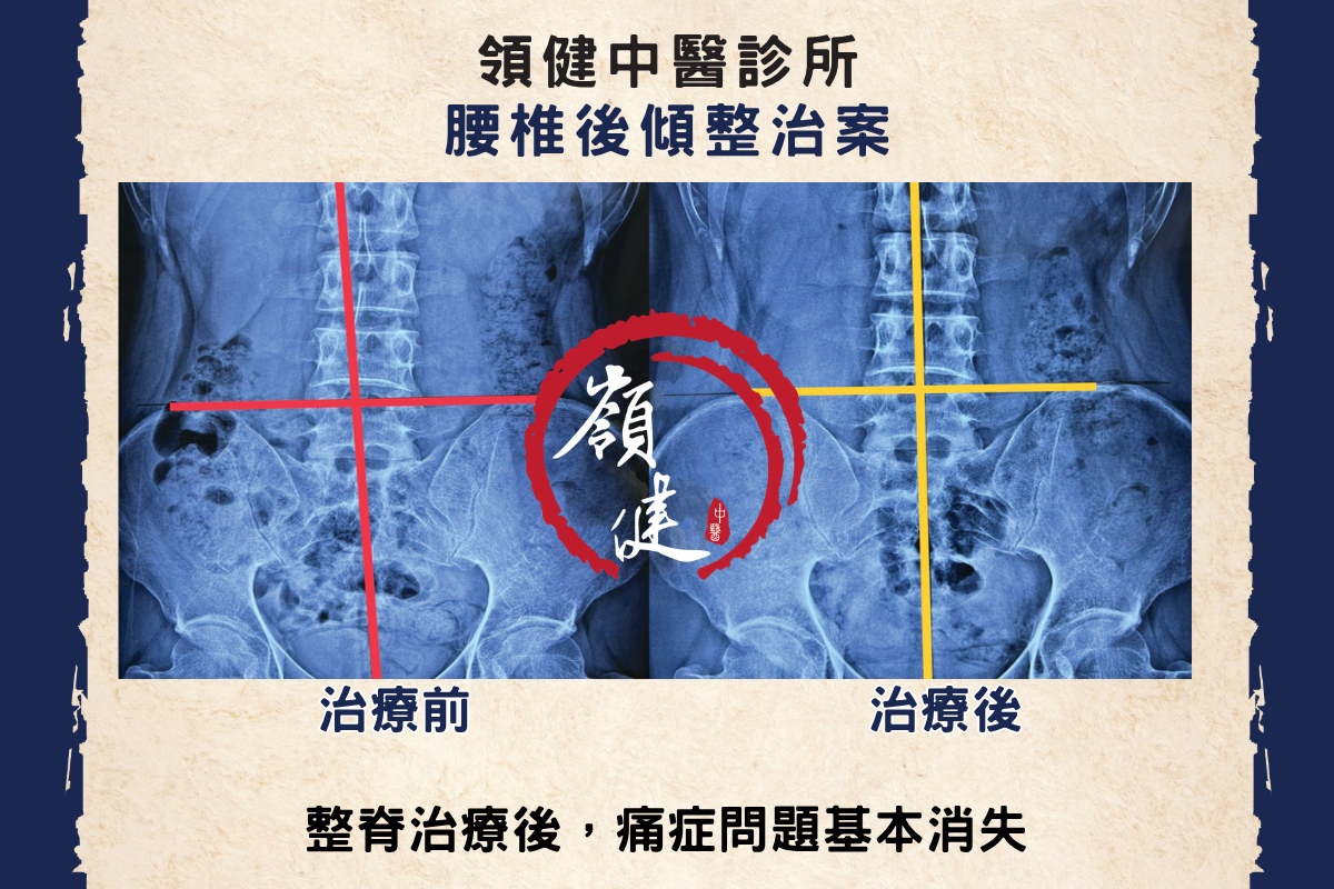 腰椎後傾整治案